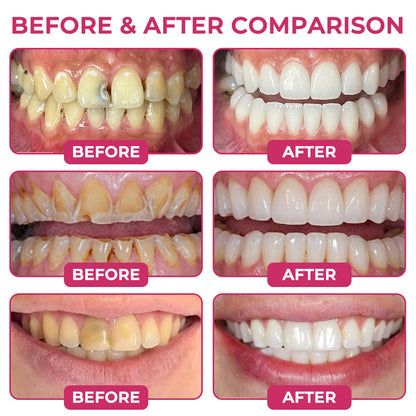 🇺🇸Rolimey® DenPerm Cavity-Repair Natural Enamel Filling Gel（JG）