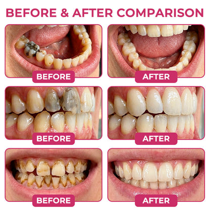 🇺🇸Rolimey® DenPerm Cavity-Repair Natural Enamel Filling Gel（JG）